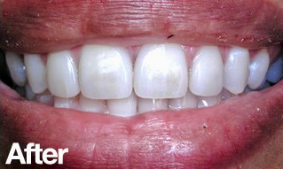 After &mdash; UNO DENTAL SAN FRANCISCO