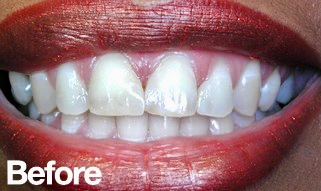 Before &mdash; UNO DENTAL SAN FRANCISCO